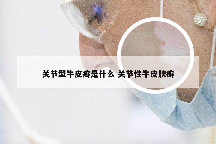 关节型牛皮癣是什么 关节性牛皮肤癣