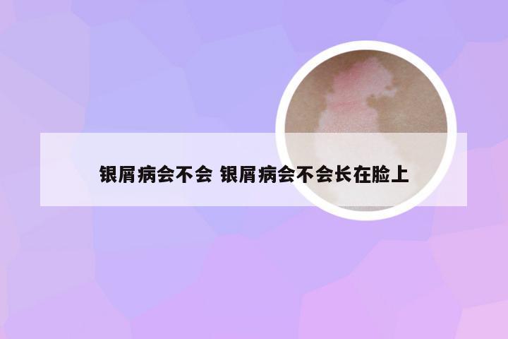 银屑病会不会 银屑病会不会长在脸上