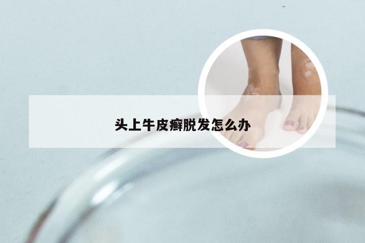 头上牛皮癣脱发怎么办