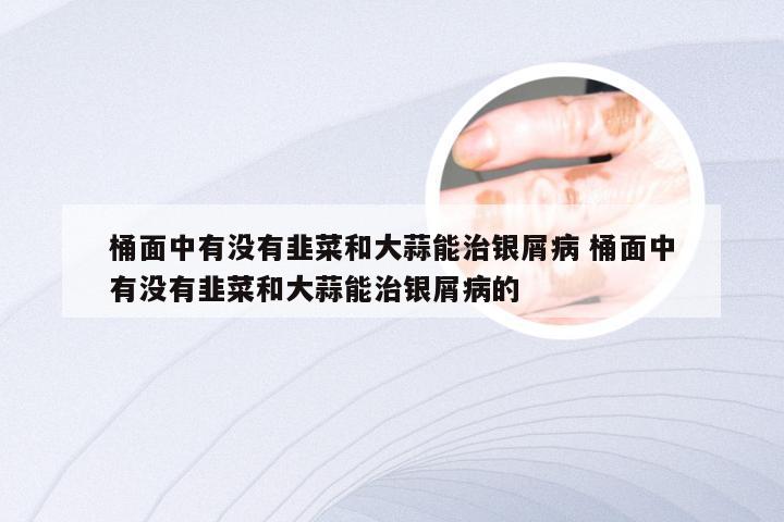 桶面中有没有韭菜和大蒜能治银屑病 桶面中有没有韭菜和大蒜能治银屑病的