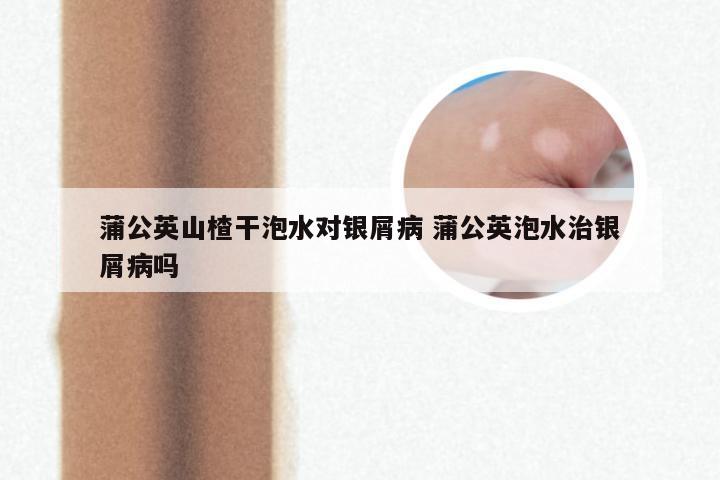 蒲公英山楂干泡水对银屑病 蒲公英泡水治银屑病吗
