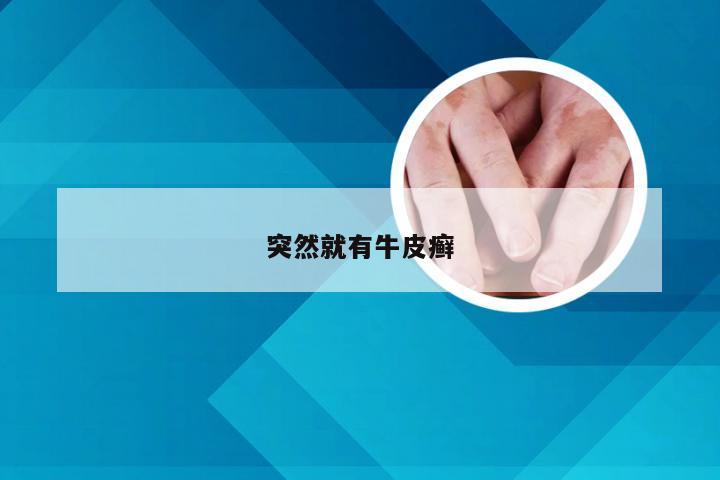 突然就有牛皮癣