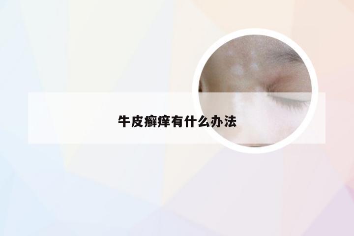 牛皮癣痒有什么办法