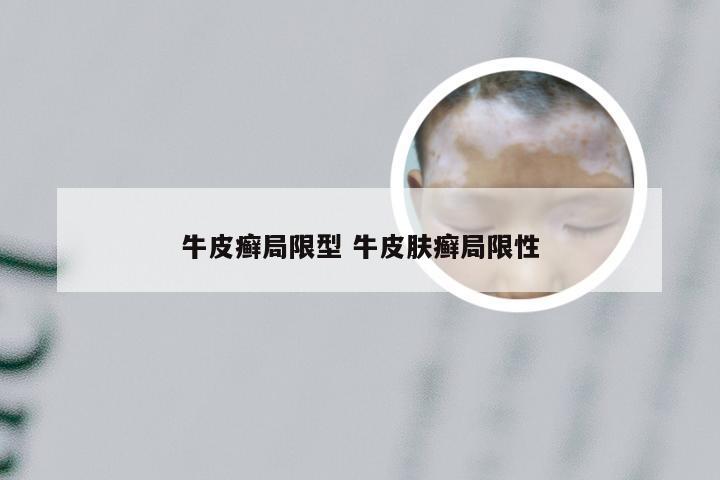 牛皮癣局限型 牛皮肤癣局限性