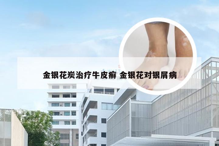 金银花炭治疗牛皮癣 金银花对银屑病
