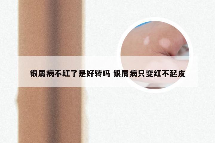 银屑病不红了是好转吗 银屑病只变红不起皮