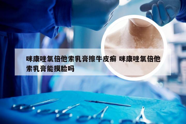 咪康唑氯倍他索乳膏擦牛皮癣 咪康唑氯倍他索乳膏能摸脸吗