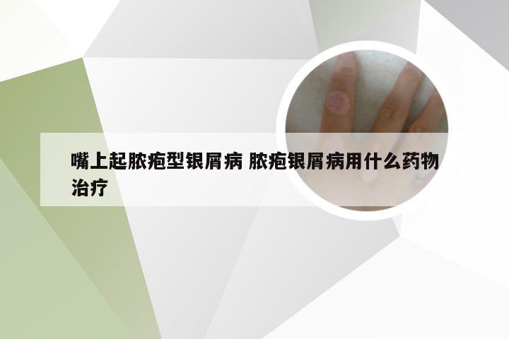 嘴上起脓疱型银屑病 脓疱银屑病用什么药物治疗