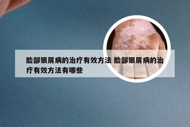 脸部银屑病的治疗有效方法 脸部银屑病的治疗有效方法有哪些