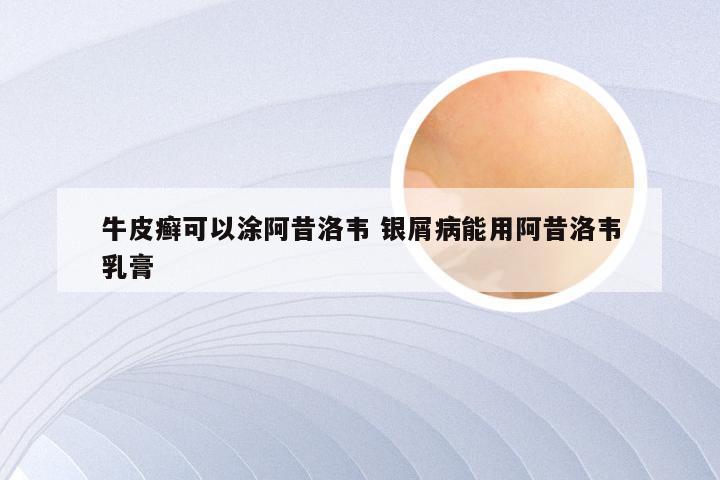牛皮癣可以涂阿昔洛韦 银屑病能用阿昔洛韦乳膏