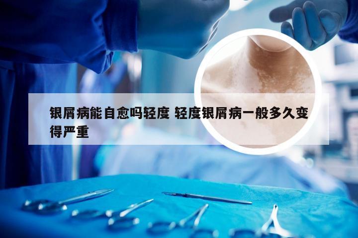 银屑病能自愈吗轻度 轻度银屑病一般多久变得严重