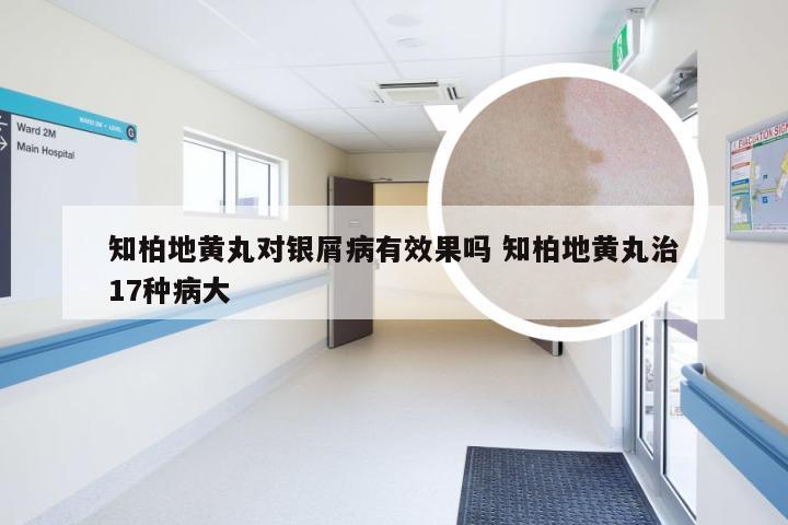 知柏地黄丸对银屑病有效果吗 知柏地黄丸治17种病大