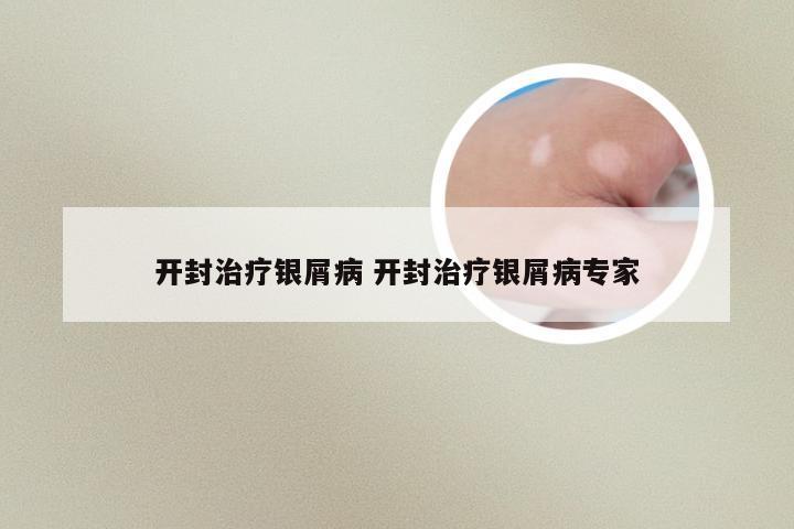 开封治疗银屑病 开封治疗银屑病专家