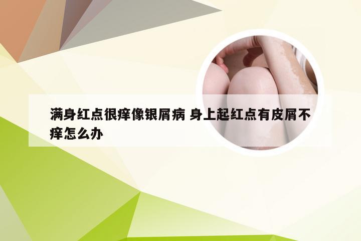 满身红点很痒像银屑病 身上起红点有皮屑不痒怎么办