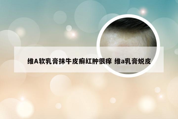 维A软乳膏抹牛皮癣红肿很痒 维a乳膏蜕皮