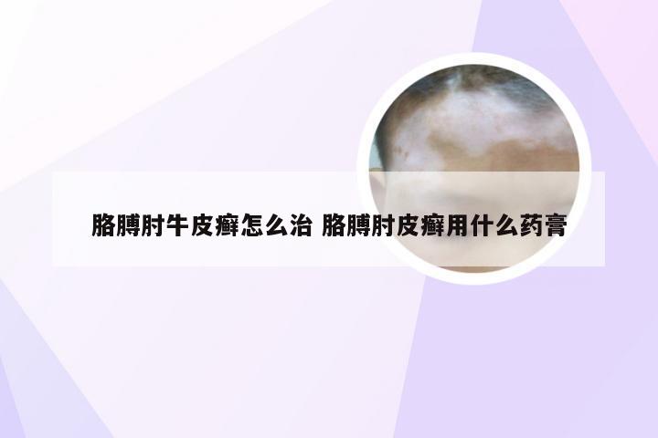 胳膊肘牛皮癣怎么治 胳膊肘皮癣用什么药膏