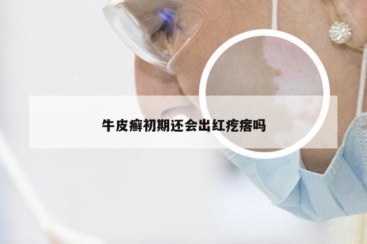 牛皮癣初期还会出红疙瘩吗