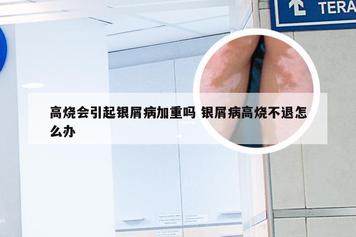 高烧会引起银屑病加重吗 银屑病高烧不退怎么办
