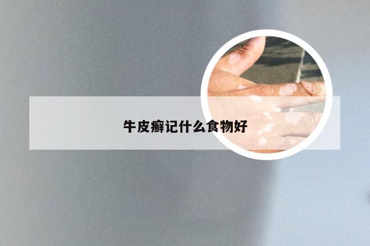 牛皮癣记什么食物好