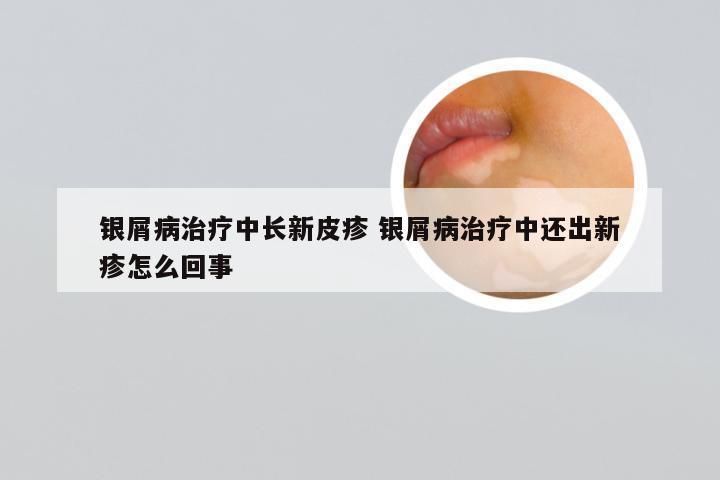 银屑病治疗中长新皮疹 银屑病治疗中还出新疹怎么回事