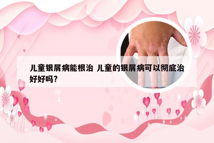 儿童银屑病能根治 儿童的银屑病可以彻底治好好吗?