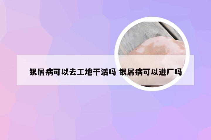 银屑病可以去工地干活吗 银屑病可以进厂吗