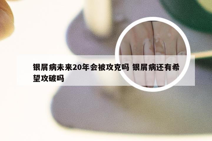 银屑病未来20年会被攻克吗 银屑病还有希望攻破吗