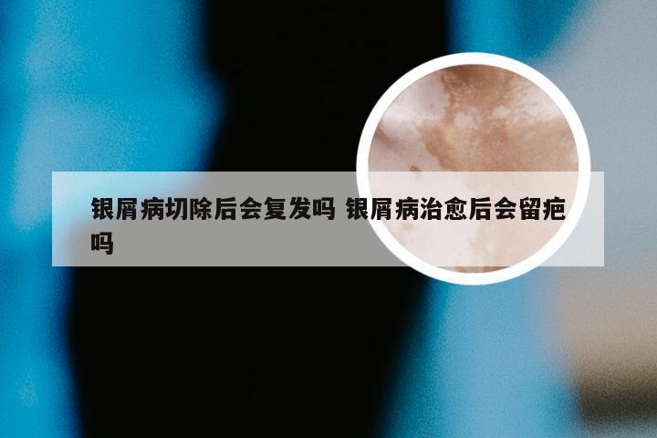 银屑病切除后会复发吗 银屑病治愈后会留疤吗