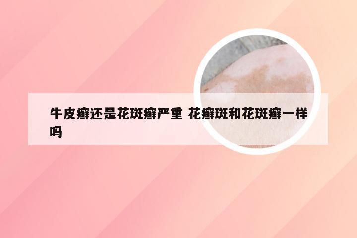 牛皮癣还是花斑癣严重 花癣斑和花斑癣一样吗