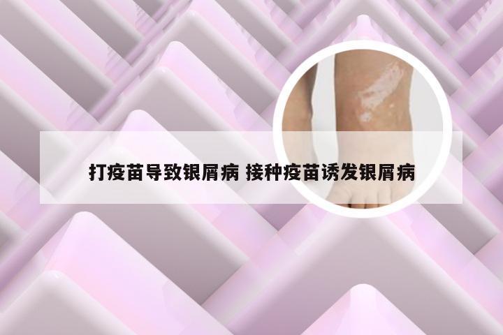 打疫苗导致银屑病 接种疫苗诱发银屑病