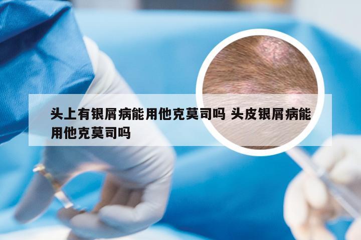 头上有银屑病能用他克莫司吗 头皮银屑病能用他克莫司吗
