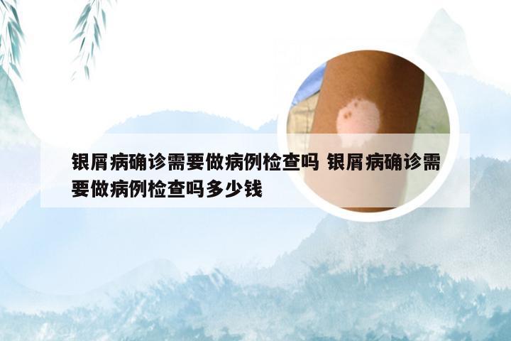 银屑病确诊需要做病例检查吗 银屑病确诊需要做病例检查吗多少钱