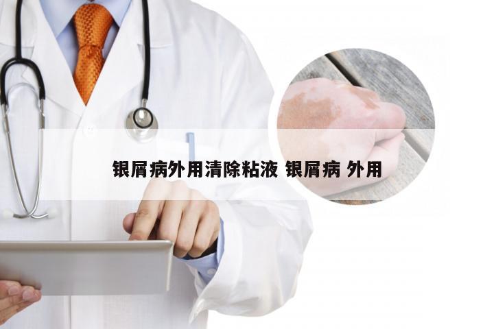 银屑病外用清除粘液 银屑病 外用