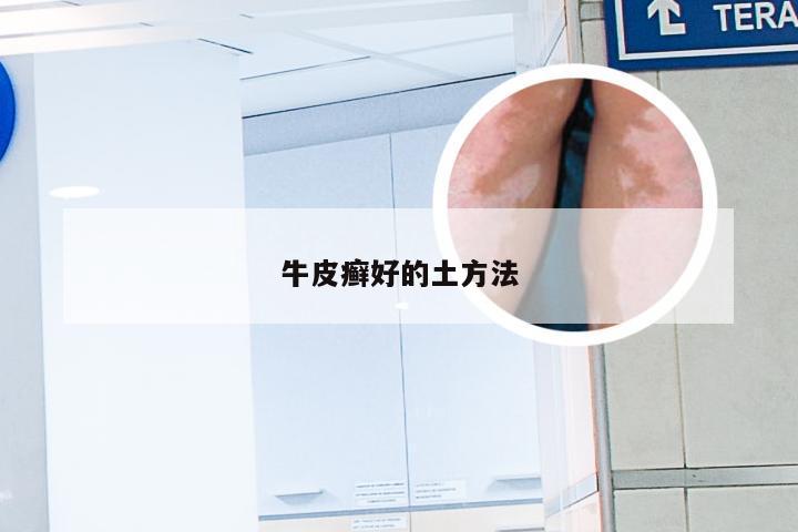 牛皮癣好的土方法
