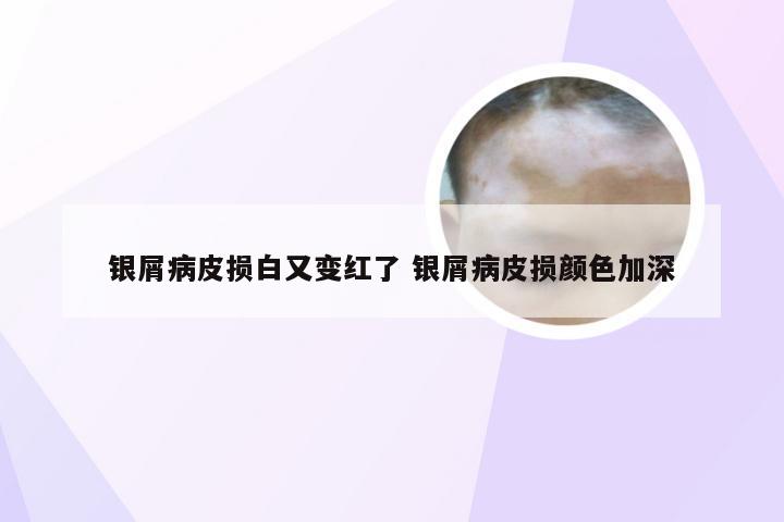 银屑病皮损白又变红了 银屑病皮损颜色加深