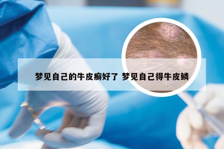 梦见自己的牛皮癣好了 梦见自己得牛皮鳞