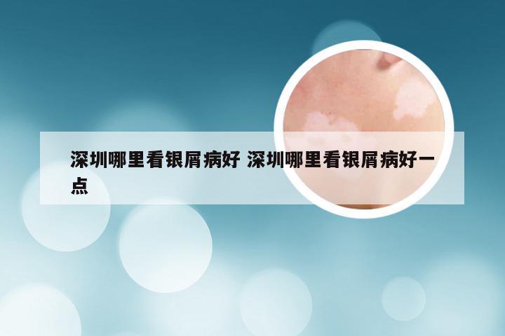 深圳哪里看银屑病好 深圳哪里看银屑病好一点