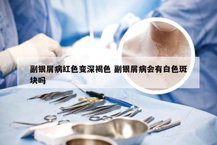 副银屑病红色变深褐色 副银屑病会有白色斑块吗
