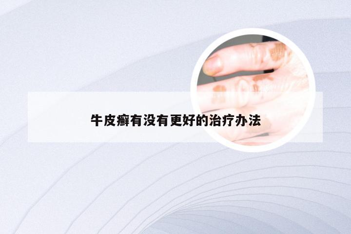 牛皮癣有没有更好的治疗办法
