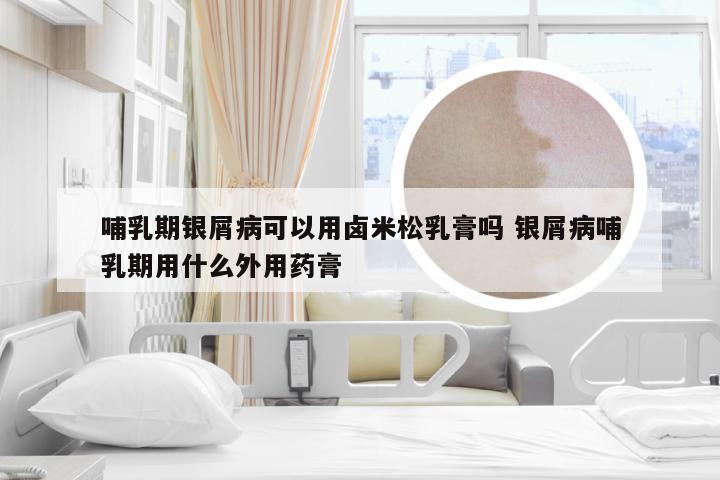 哺乳期银屑病可以用卤米松乳膏吗 银屑病哺乳期用什么外用药膏