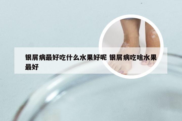银屑病最好吃什么水果好呢 银屑病吃啥水果最好