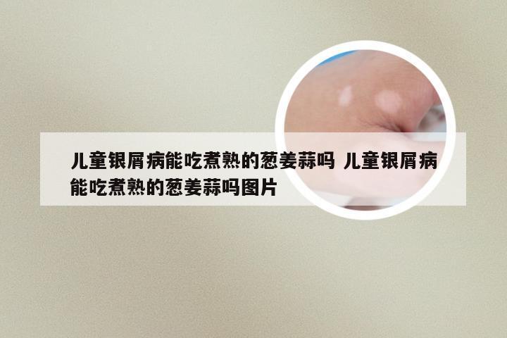 儿童银屑病能吃煮熟的葱姜蒜吗 儿童银屑病能吃煮熟的葱姜蒜吗图片