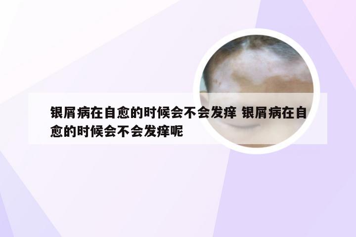 银屑病在自愈的时候会不会发痒 银屑病在自愈的时候会不会发痒呢