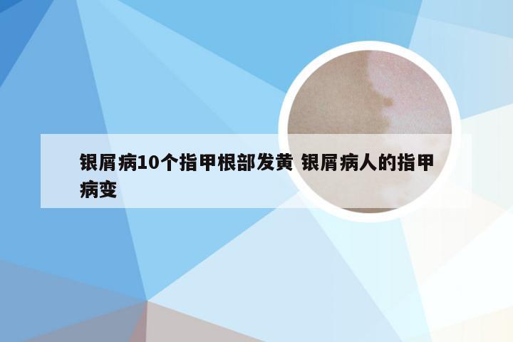 银屑病10个指甲根部发黄 银屑病人的指甲病变
