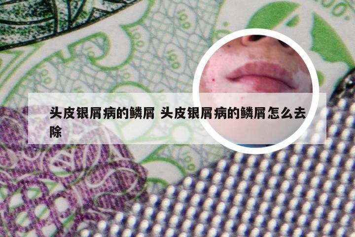 头皮银屑病的鳞屑 头皮银屑病的鳞屑怎么去除