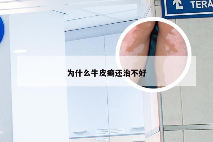 为什么牛皮癣还治不好