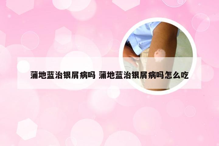 蒲地蓝治银屑病吗 蒲地蓝治银屑病吗怎么吃