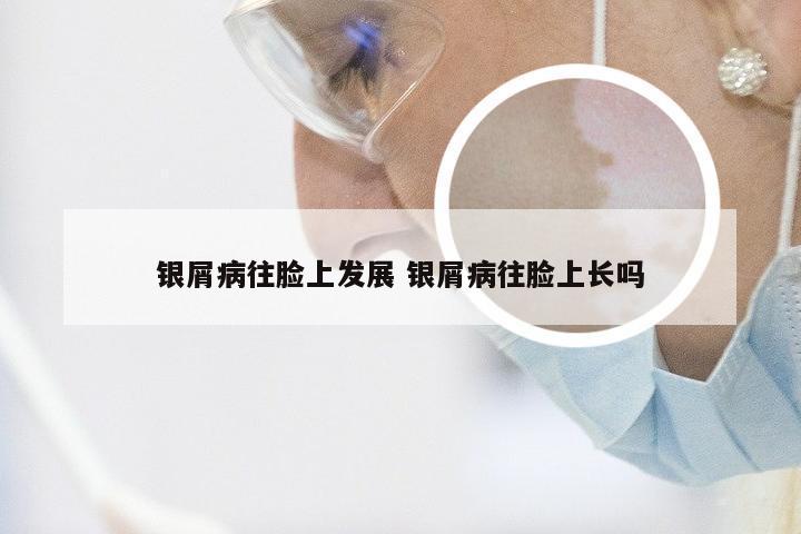 银屑病往脸上发展 银屑病往脸上长吗