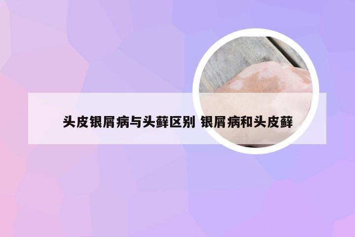 头皮银屑病与头藓区别 银屑病和头皮藓