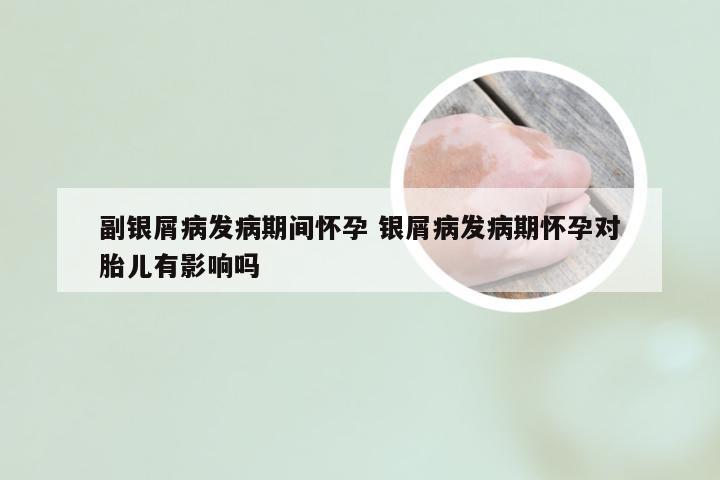 副银屑病发病期间怀孕 银屑病发病期怀孕对胎儿有影响吗